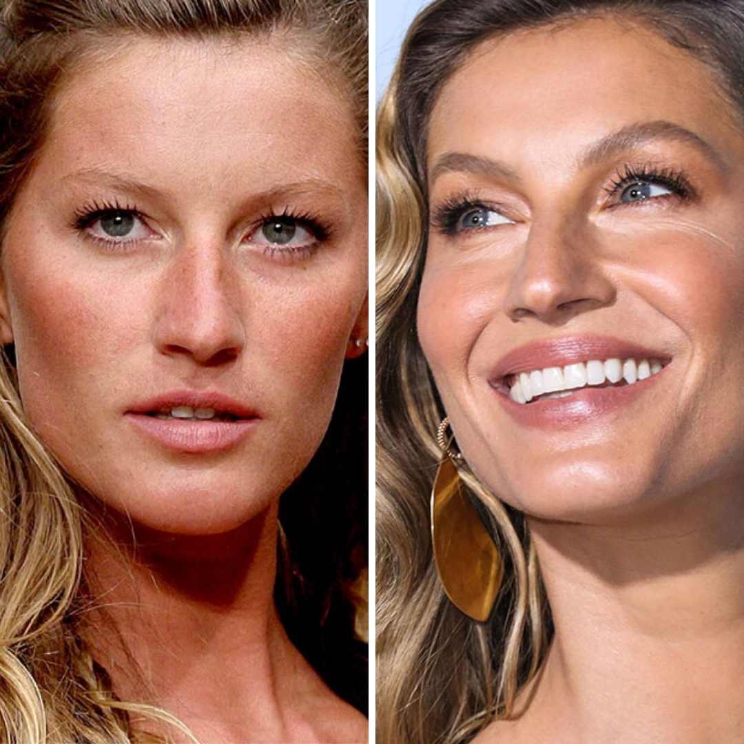 Жизель Бюндхен до лечения элайнерами и после