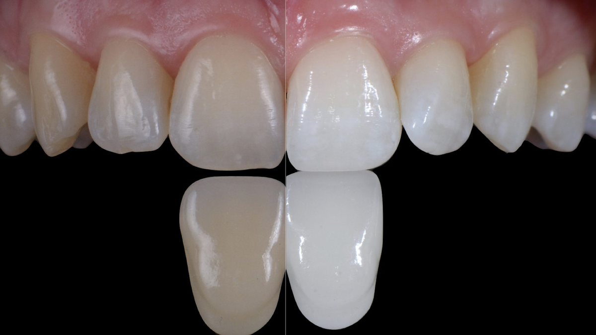 Процедуры отбеливания зубов условно делятся на профессиональные и непрофессиональные.