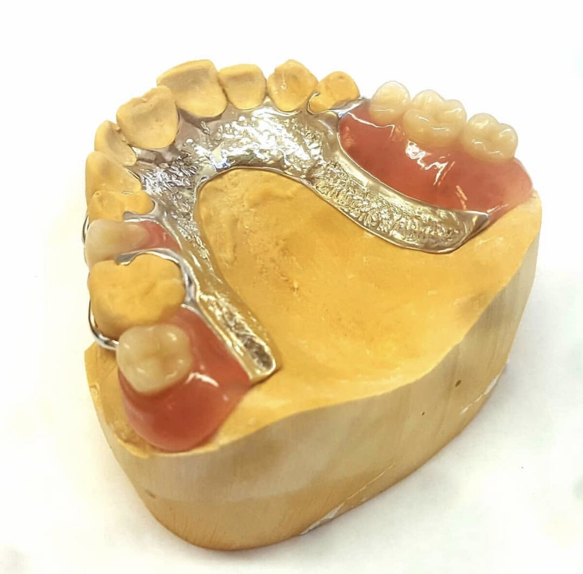 НА ФОТО: КЛАССИЧЕСКИЙ БЮГЕЛЬНЫЙ ПРОТЕЗ НА КЛАММЕРАХ