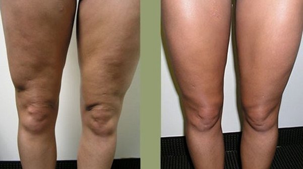 Inner Thigh Lipo