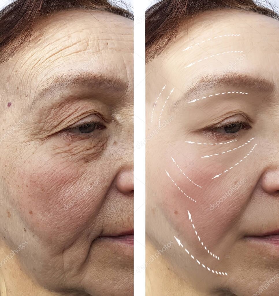 Домашний способ омолодить лицо. Морщины на лице уйдут. Рецепт молодости для всех женщин.