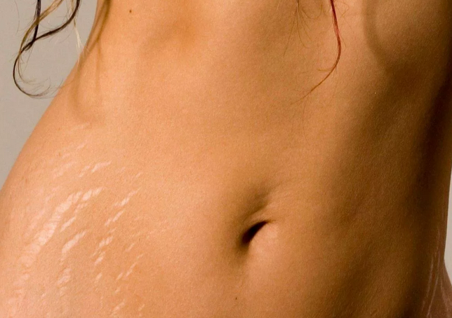 Растяжки на животе