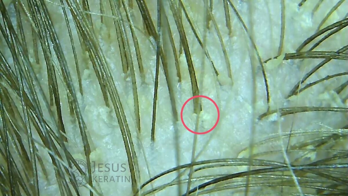 Сальные пробки