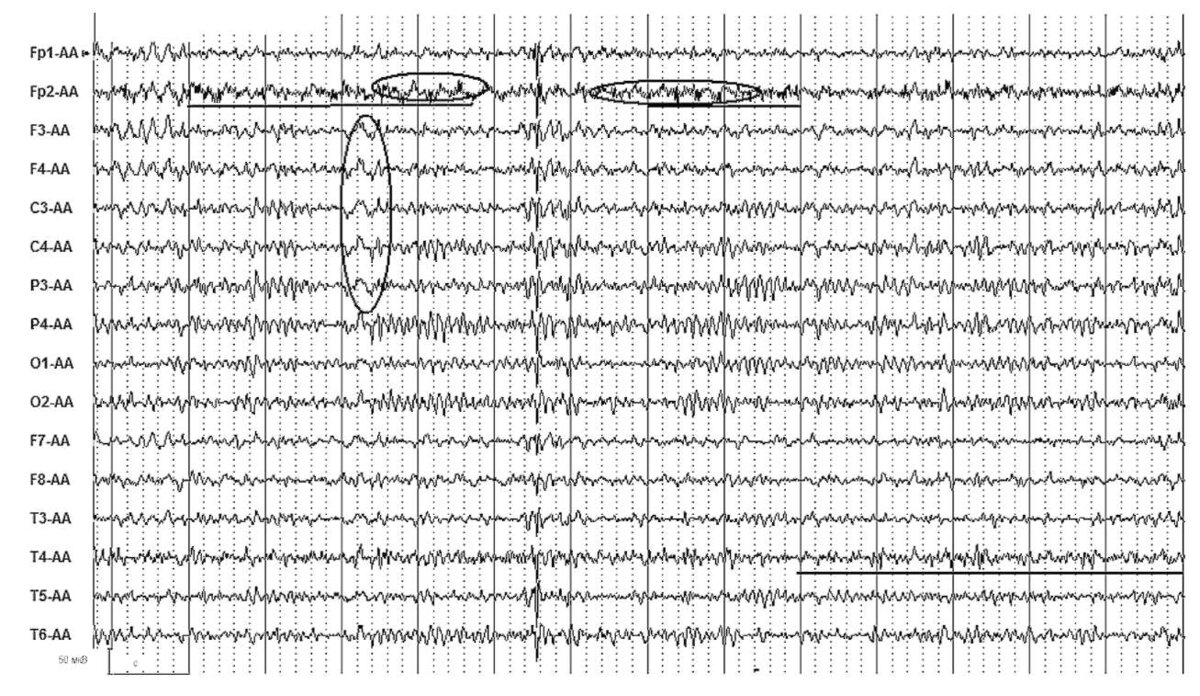 ЭЭГ диффузные изменения биоэлектрической активности головного мозга