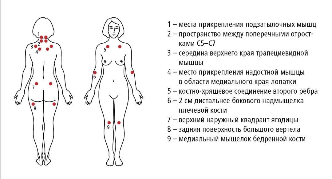 Болезнынные точки при фибромиалгии