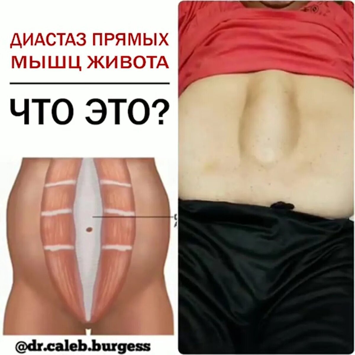 Диастаз это простыми словами фото Три проблемы живота после беременности: стрии, диастаз, лишняя кожа. Фото не для