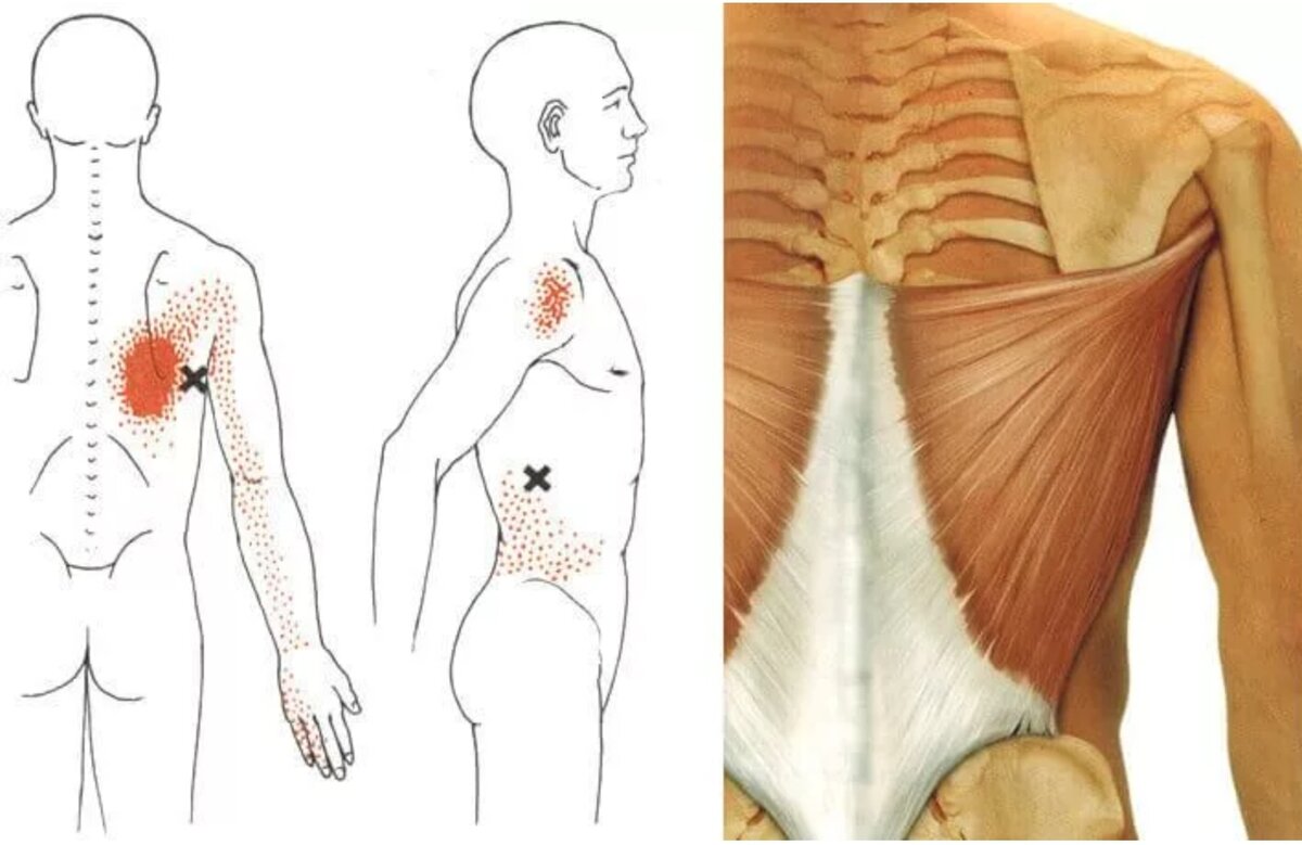 Спина спайка. Миофасциальный синдром триггерные точки. Триггерные точки в широчайшей мышце. Триггерные точки широчайшей мышцы спины. Миофасциальный синдром триггерные точки спины.