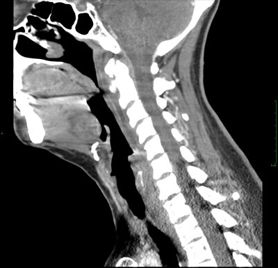 КТ шейного отдела позвоночника