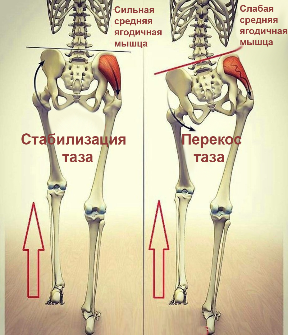 Нарушение биомеханики шага. Слабость средней ягодичной мышцы. Перекос таза.  | Сам Себе Ортопед. Спб. | Дзен