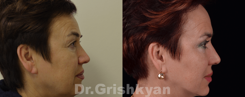 Подтяжка лица SMAS фото до и после. Фото с сайта Д.Р. Гришкяна. Имеются противопоказания, требуется консультация специалиста