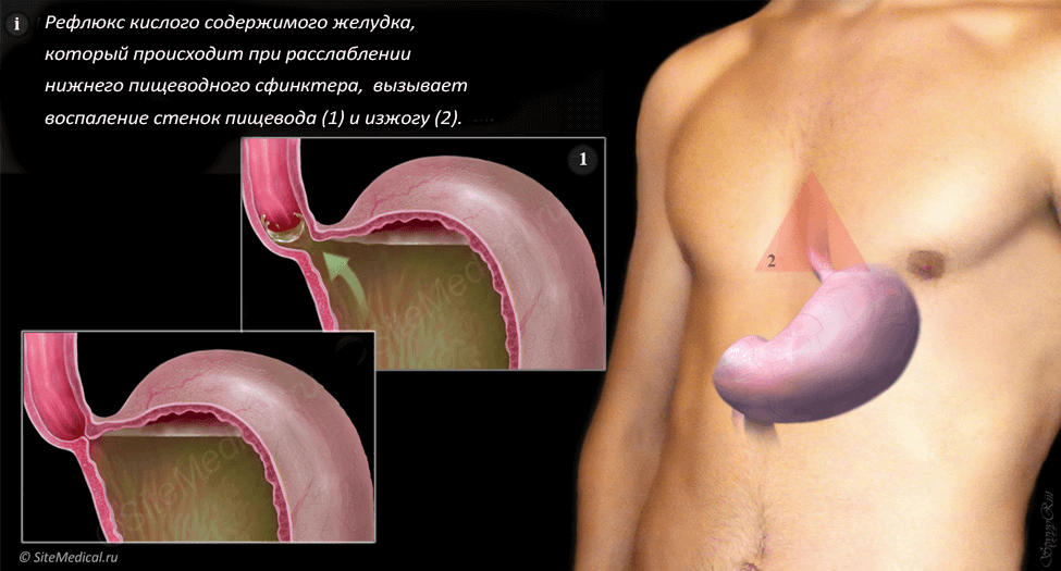 Боль пищевода симптомы. Гастрит рефлюкс эзофагит. Хронический неэрозивный рефлюкс эзофагит. Сфинктеры желудка и пищевода.