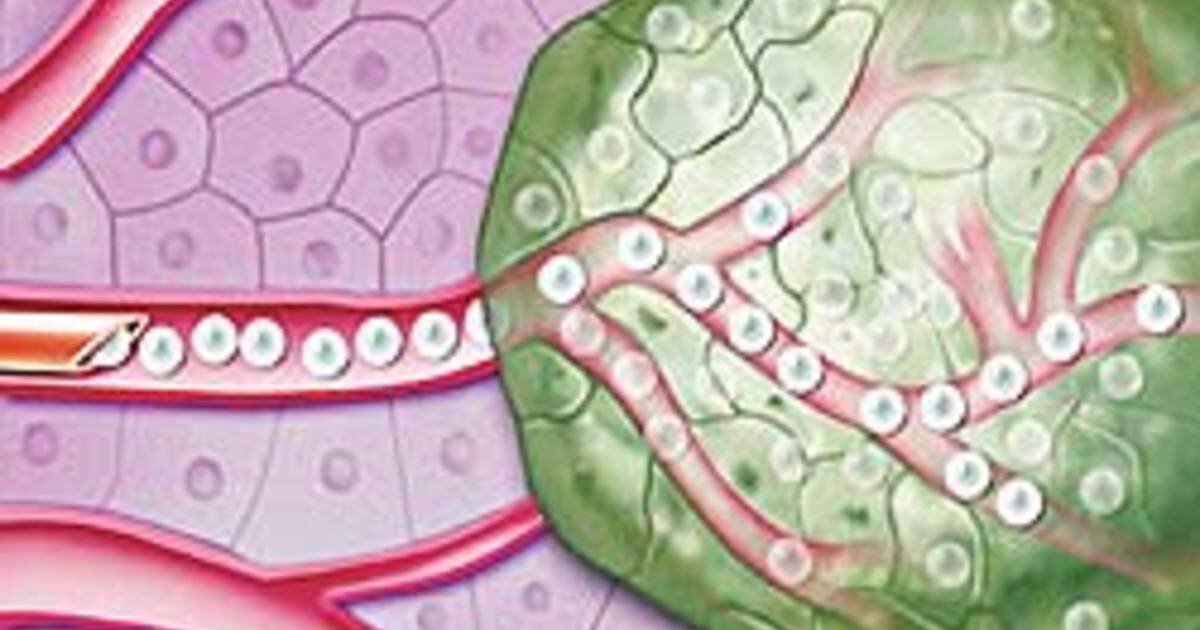 доставка микросфер к опухоли - изображение с сайта newizv.ru