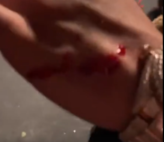 Посмотри на мою руку бро! Эта сучка укусила мою гребаную руку!