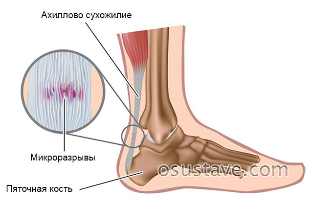 Лечение сухожилий