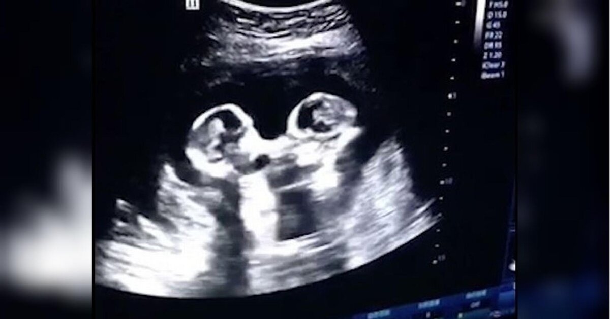 Снимки УЗИ.