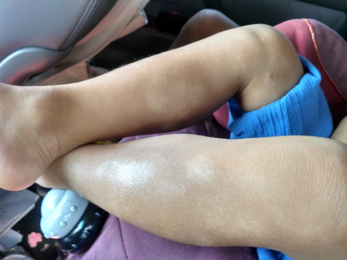 Дочины ножки после моря. Белые пятна - места вылеченных на море экзем, не загорели, как шрамы. Покрыто болячками было больше половины кожи.