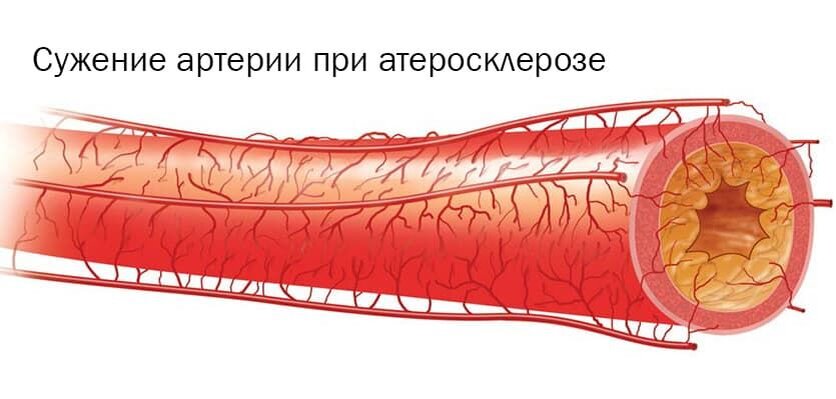 Чувствительные сосуды. Атеросклеротическое поражение кровеносных сосудов. Атеросклероз сосудов БЦС. Атеросклероз генерализованный 170.9. Атеросклероз венечных артерий.