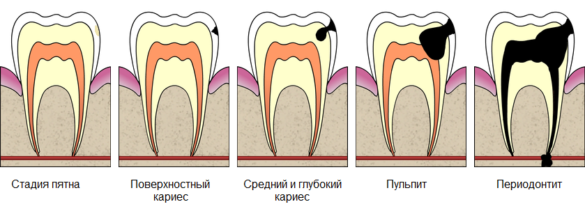 Может ли болеть зуб после лечения кариеса