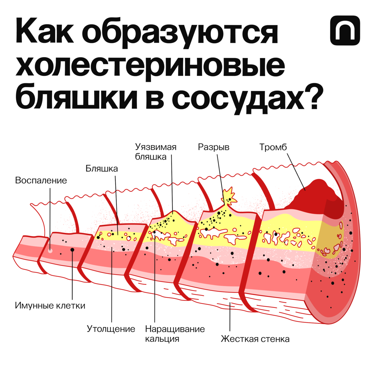 Атеросклероз сосудов