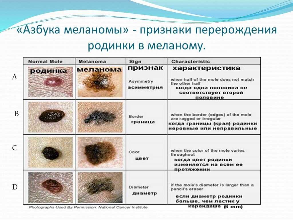 Бородавки, папиломы, родинки — о чем организм пытается нас предупредить?  Рассмотрим самые важные тонкости этих явлений! | Диетолог Николай Тихенко |  Дзен