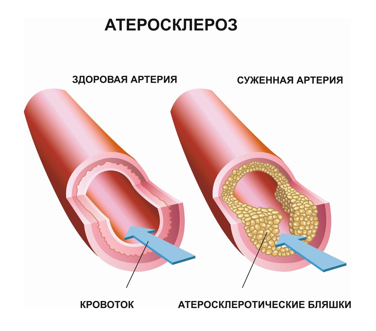 Атеросклероз у взрослого. Атеросклеротическая бляшка. Корональный атеросклероз.