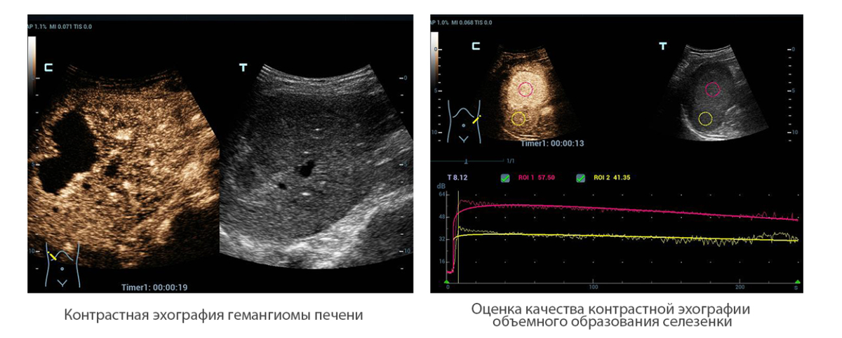 Область узи. Mindray Resona. Контрастная эхография динамическая. Контрастное УЗИ. Эхоконтрастирование в УЗИ.