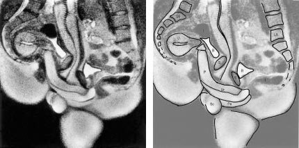 Midsagittal image of the anatomy of sexual intercourse (experiment 12). P=penis, Ur=urethra, Pe=perineum, U=uterus, S=symphysis, B=bladder, I=intestine, L5=lumbar 5, Sc=scrotum. Image source: Schultz et al., 1999, The BMJ