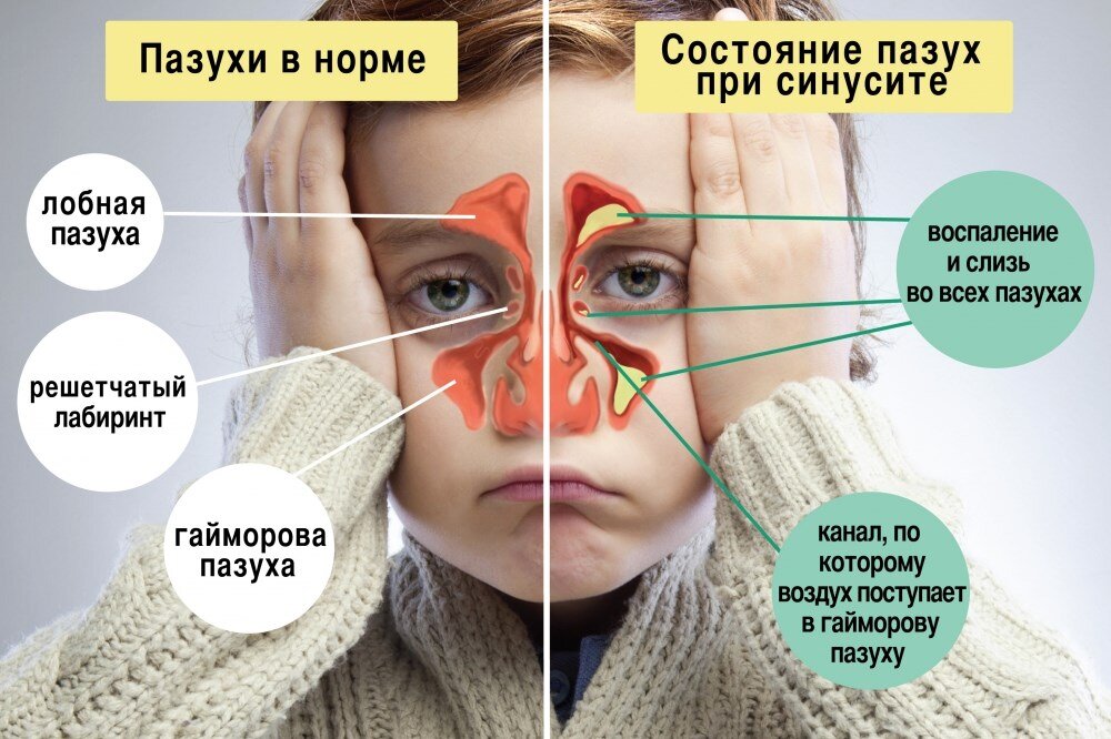 Современный подход в лечении гайморита