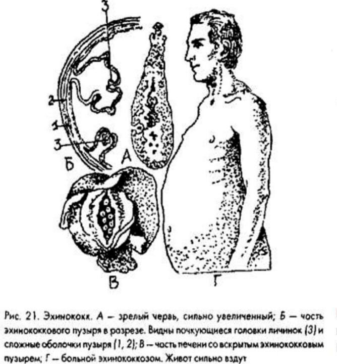 Эхинококк симптомы заражения у человека