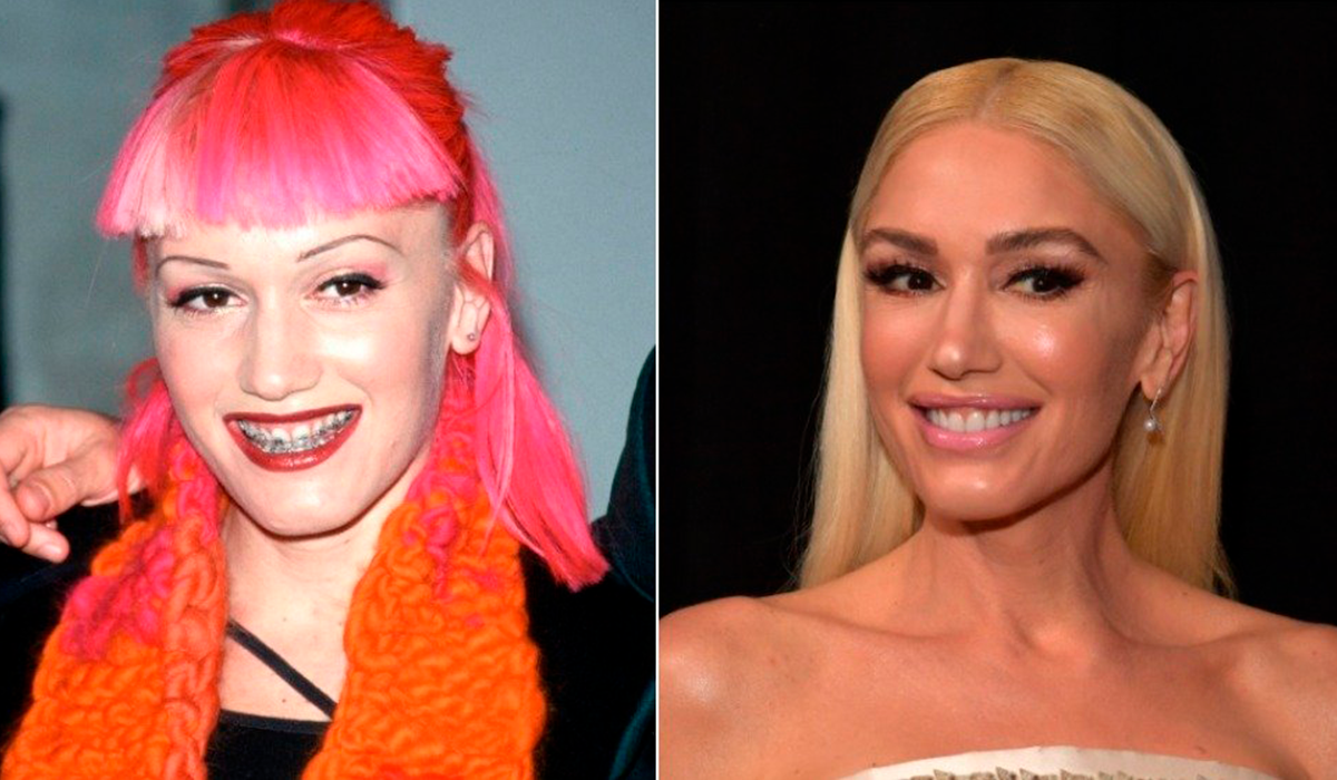 Smile Makeover: Gwen Stefani's Transformation - NewBeauty Smile makeover, Cosmet