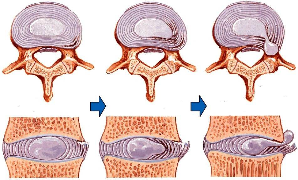 Грыжа диска спина. Грыжа диска и протрузия диска. Грыжи и протрузии позвоночника. Протрузия грыжа межпозвонковых дисков. Протрузия дисков позвоночника и грыжа диска.