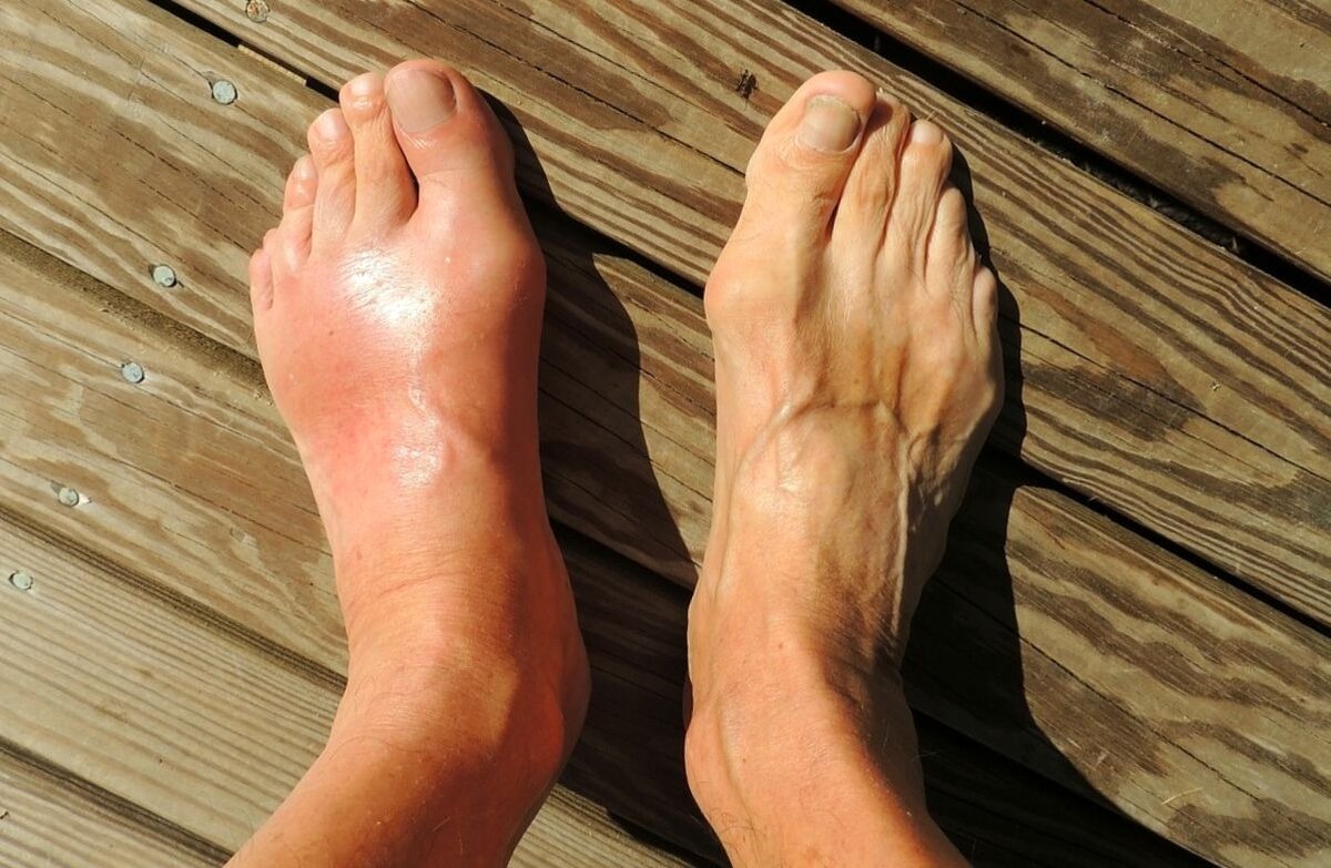 вторичная подагра - болезнь "достатка" "Жизнь в Радость"