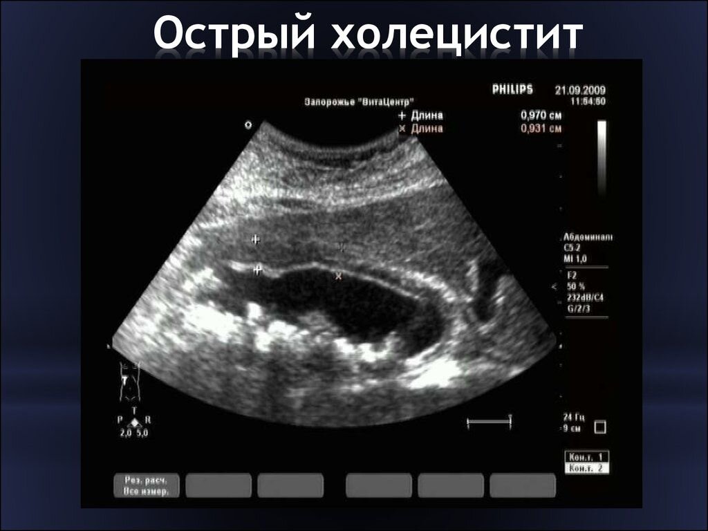 Холестероз желчного пузыря в уз изображении характеризуется