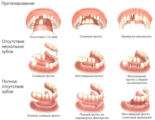 Источник: https://ozubkah.ru