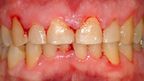 Кровоточивость десен – один из признаков воспалительного процесса