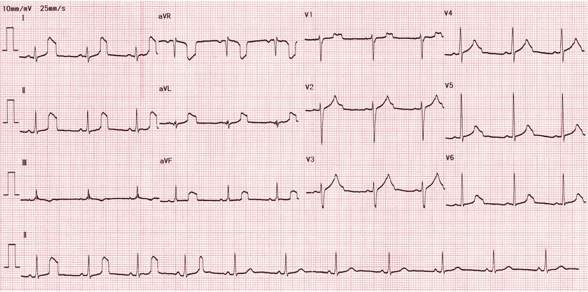 Артефакты экг. Артефакты на экг при холтеровском мониторировании. Артефакты движения глаз на ээг. Физиологические артефакты ээг. Артефакты эмг при ээг.