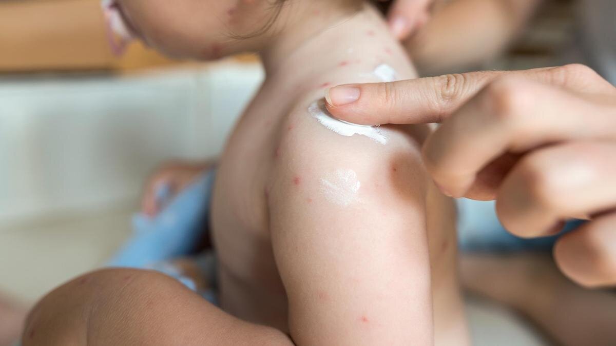    Ветряная оспа:Getty Images / Mixmike