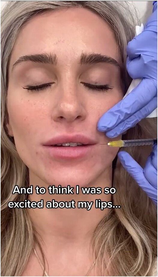 Блогер на трансляции из косметологического кабинета в момент установки филлеров tiktok.com/@kokobeaute