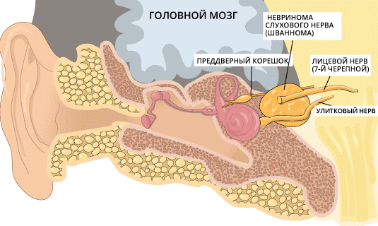 Что нужно знать о НЕВРИНОМЕ СЛУХОВОГО НЕРВА? Причины, симптомы, прогноз ...
