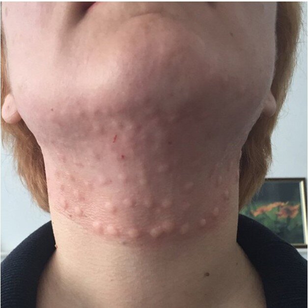 Инъекции липолитика