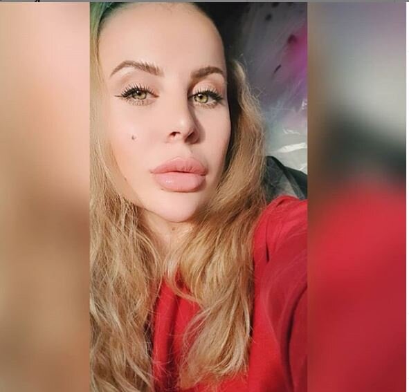 Ольга после увеличения губ