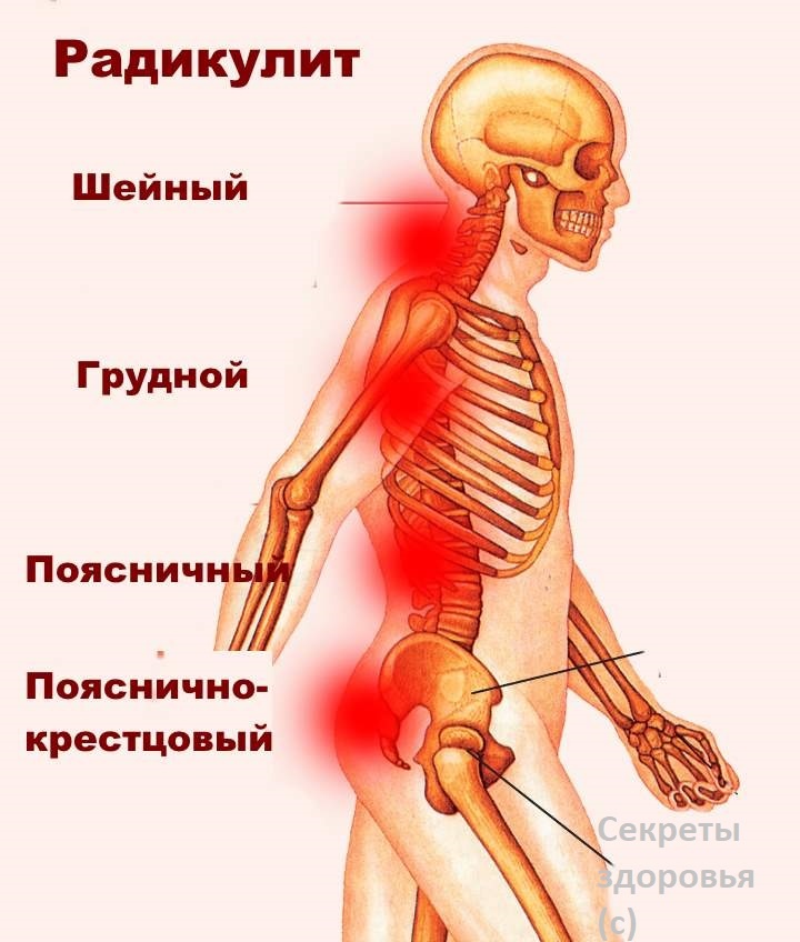 Боли при радикулите