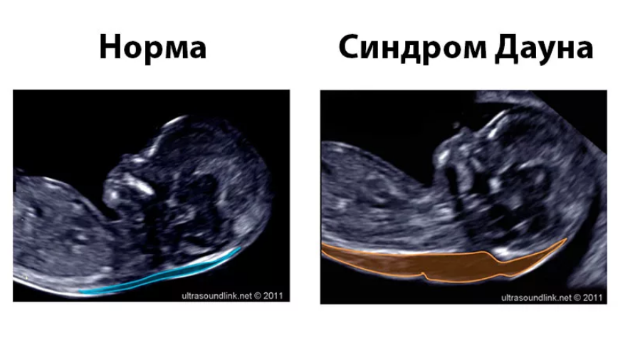 Шейно воротниковая зона узи. УЗИ-скрининг 1 синдром Дауна. Синдром Дауна на УЗИ 12 недель. Скрининг УЗИ синдром Дауна. УЗИ первый скрининг синдром Дауна.