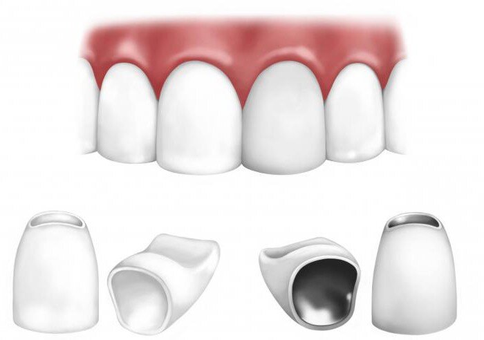 Металлокерамические коронки