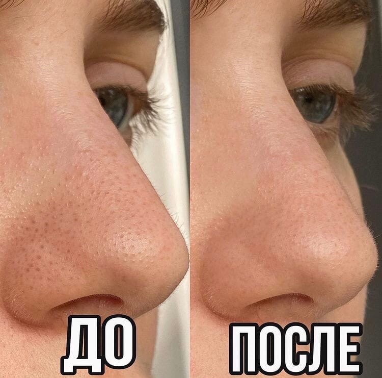 сужаем поры за неделю