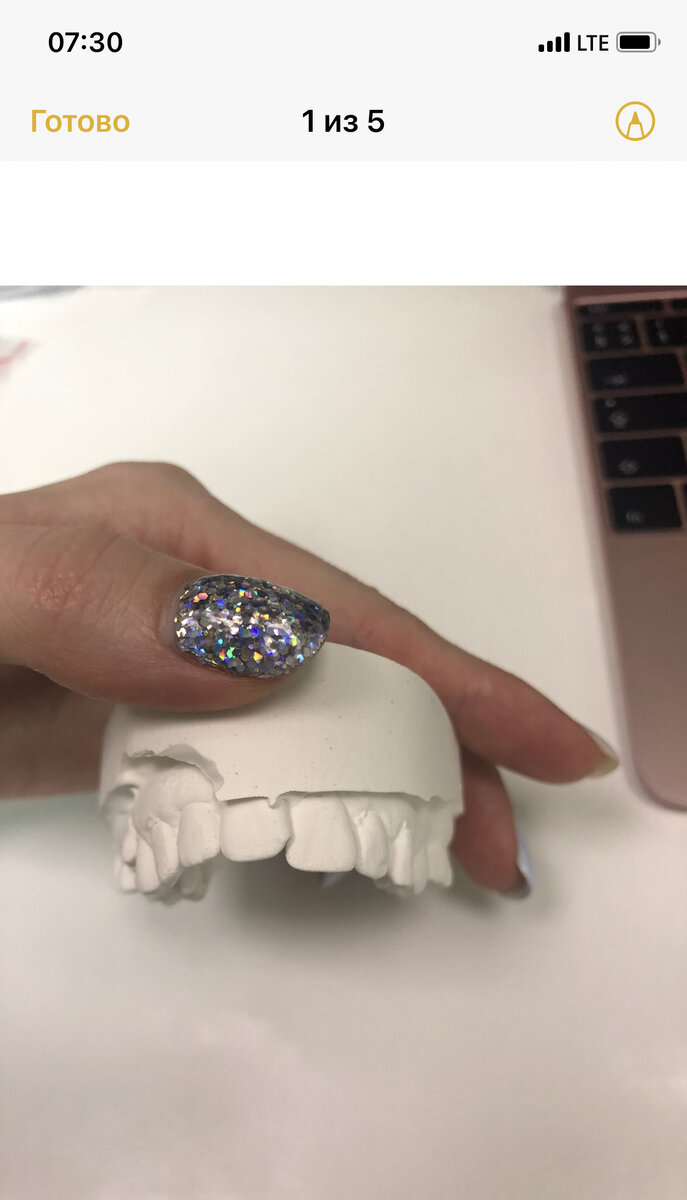 Верхняя челюсть 