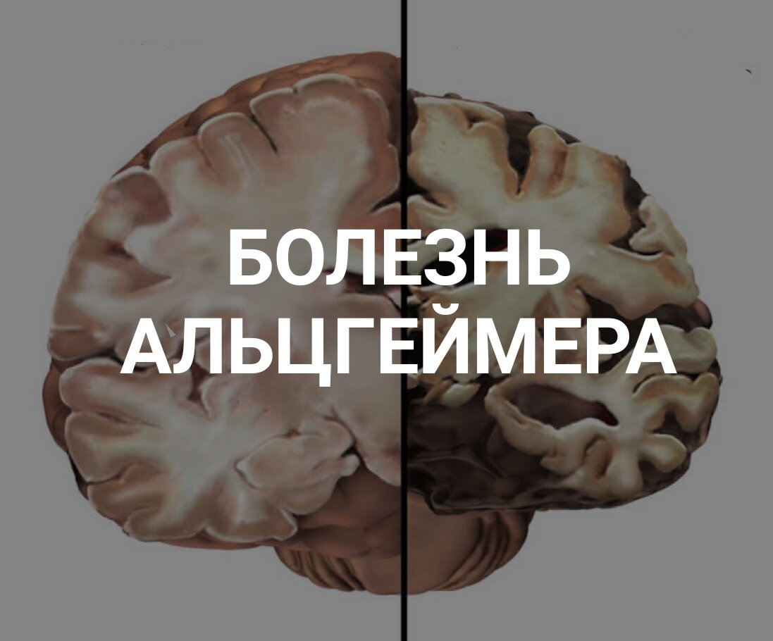 Лев. фото мозг обычного человека. Прав. фото мозг человека страдающего болезнью Альцгеймера