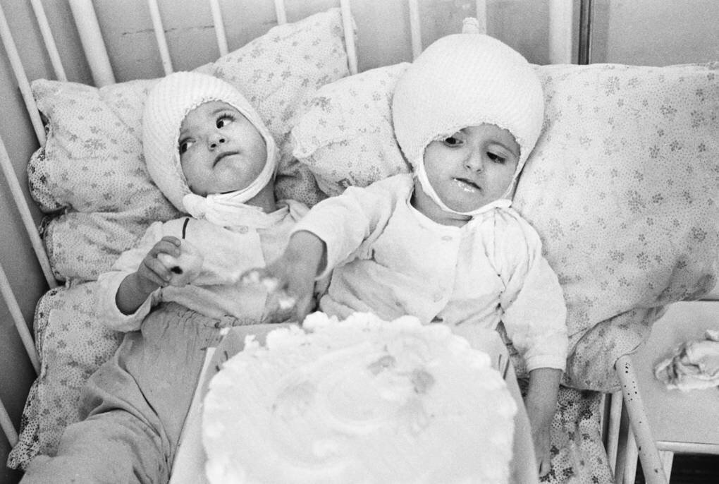 Вилия и виталия сиамские близнецы фото