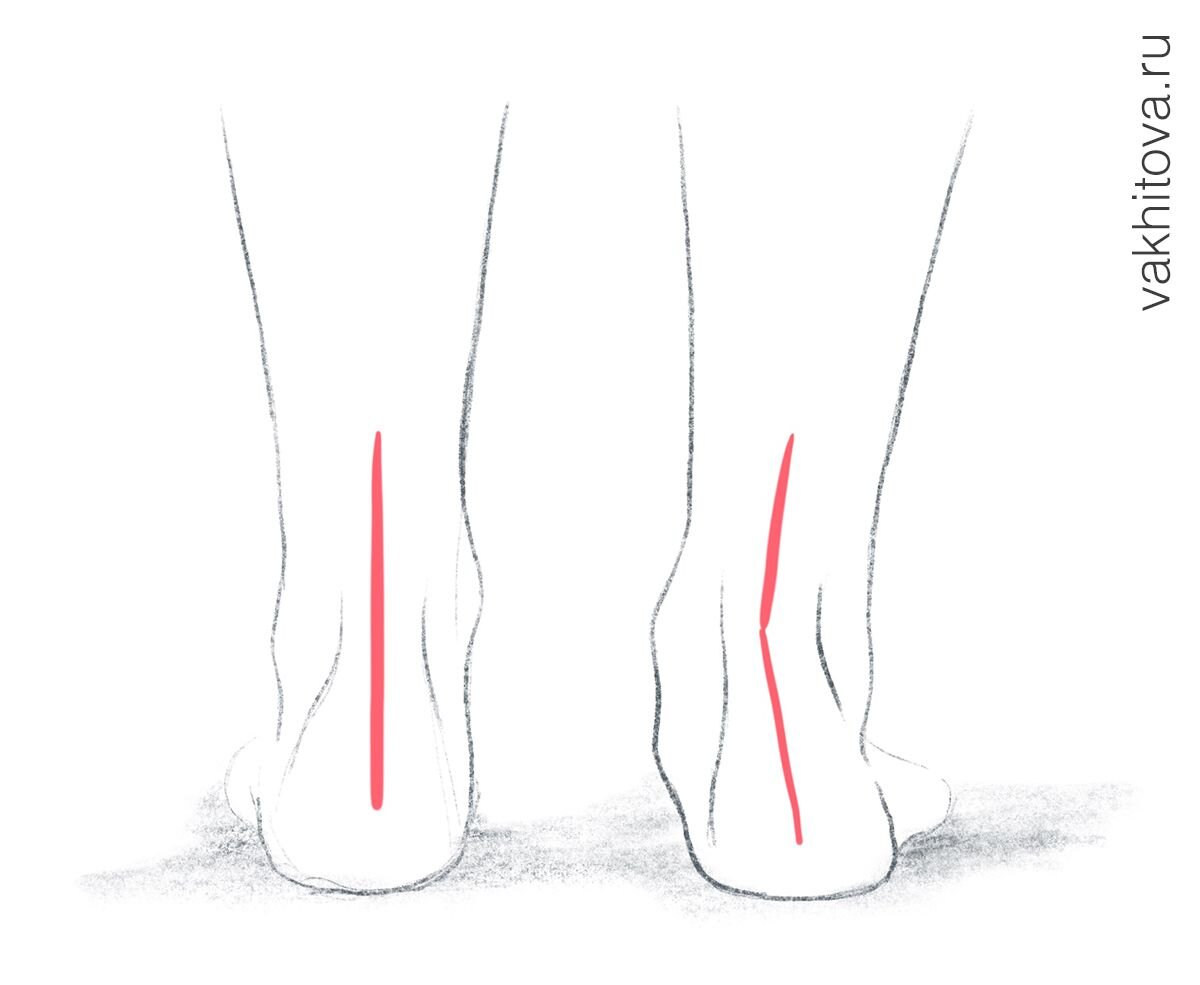 Стопы внутрь. Вальгусная деформация пяточной кости. Пяточно вальгусная деформация стопы.