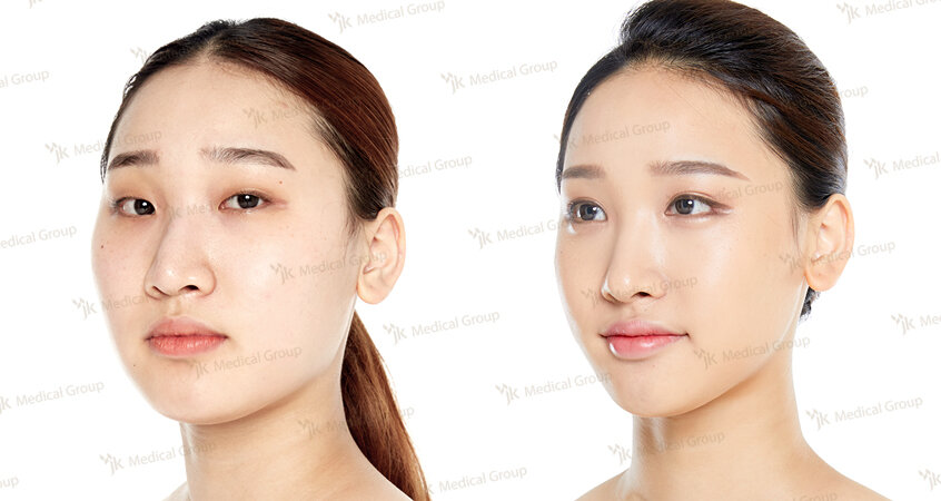 Кореянки до и после операции. Кореянки до и после операции. Операция по изменению формы лица. Плоское лицо. Операция по изменению формы лица.